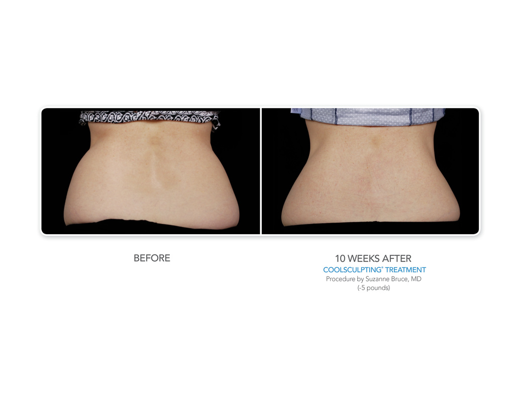 Reduce Love Handles with Coolsculpting Freeze it Away