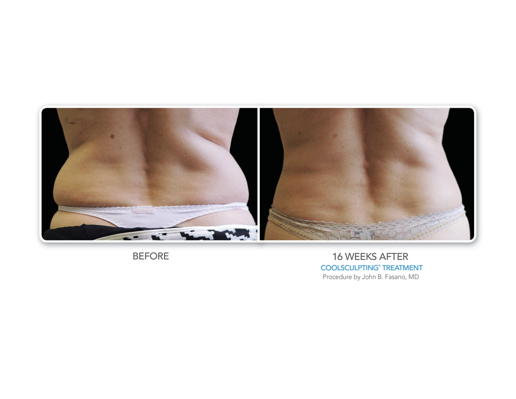 Coolsculpting love handles before sales and after